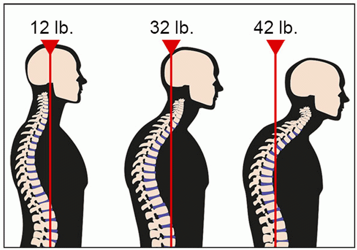 forward-head-posture2